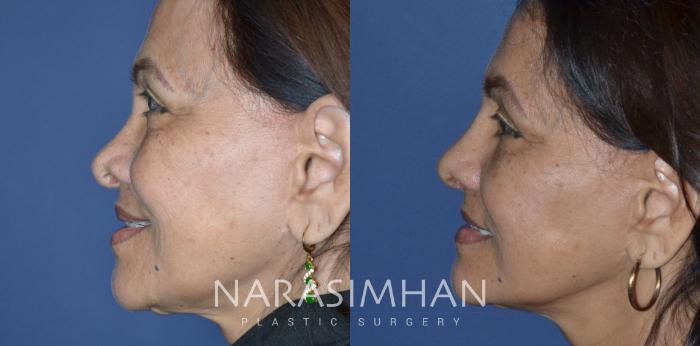Before & After Revision Rhinoplasty Case 334 Left Side View in Tampa, Florida