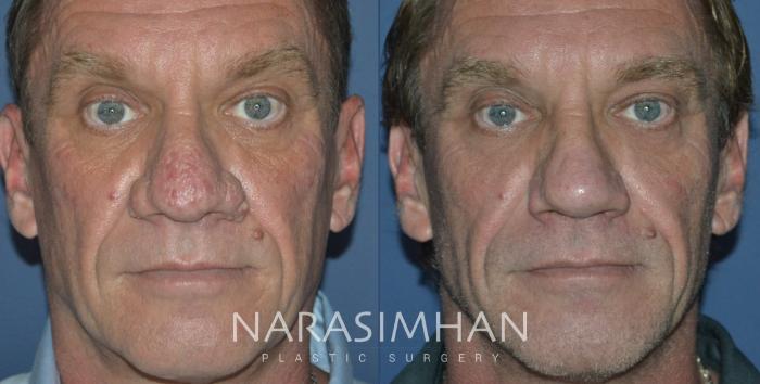 Before & After Rhinoplasty Case 293 Front View in Tampa, Florida