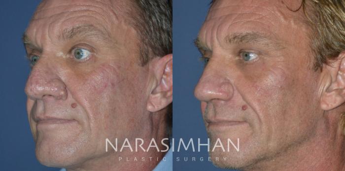 Before & After Rhinoplasty Case 293 Left Oblique View in Tampa, Florida