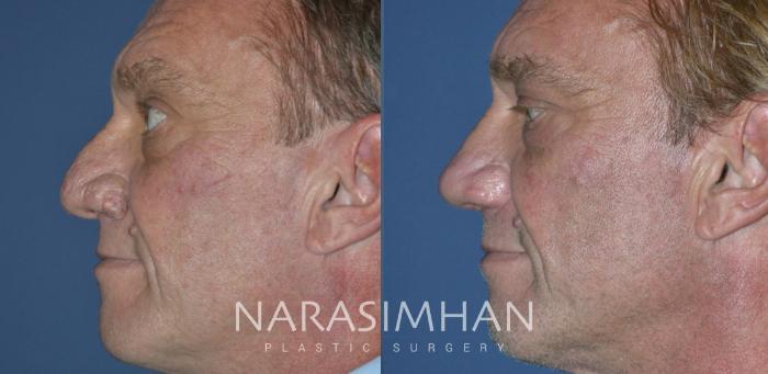 Before & After Rhinophyma Removal Case 293 Left Side View in Tampa, Florida