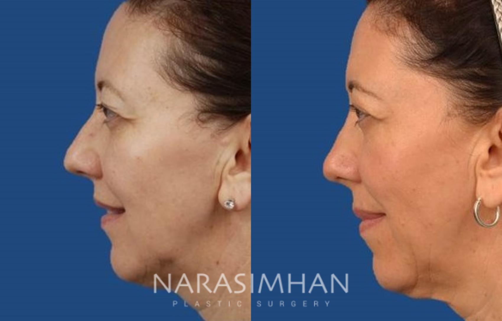 Before & After Rhinoplasty Case 104 View #1 View in St. Petersburg, Florida
