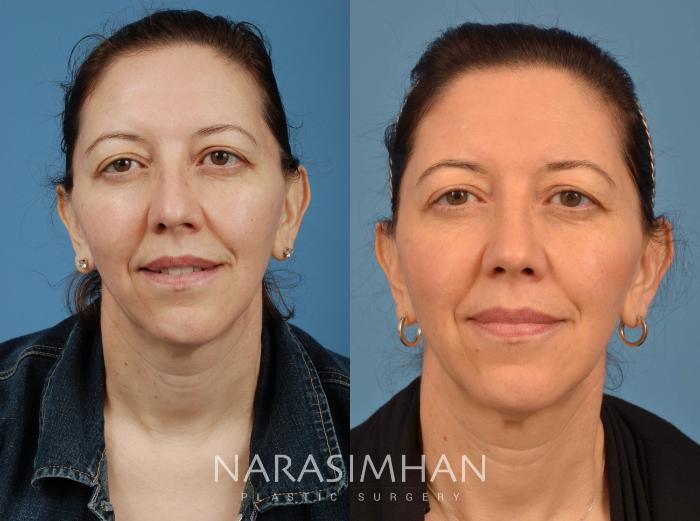 Before & After Rhinoplasty Case 104 View #2 View in Tampa, Florida