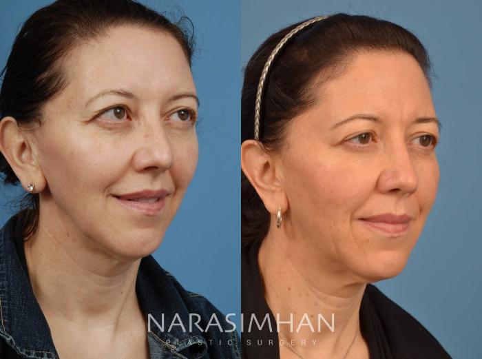 Before & After Rhinoplasty Case 104 View #3 View in Tampa, Florida