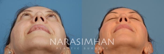 Before & After Rhinoplasty Case 104 View #4 View in Tampa, Florida
