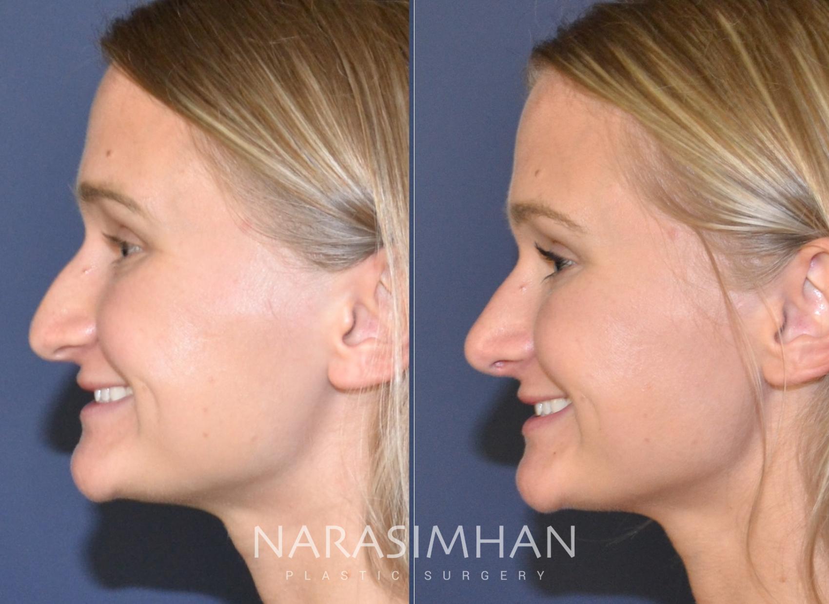 Before & After Rhinoplasty Case 132 View #1 View in St. Petersburg, Florida