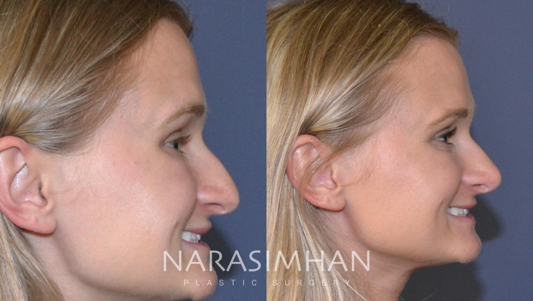 Before & After Rhinoplasty Case 132 View #2 View in St Petersburg, Florida
