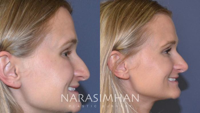 Before & After Rhinoplasty Case 132 View #2 View in Tampa, Florida