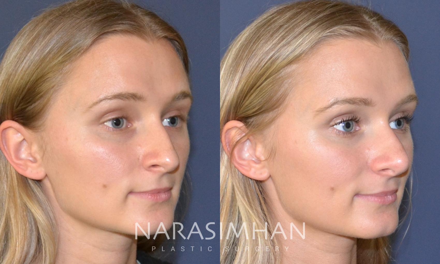 Before & After Rhinoplasty Case 132 View #3 View in St Petersburg, Florida