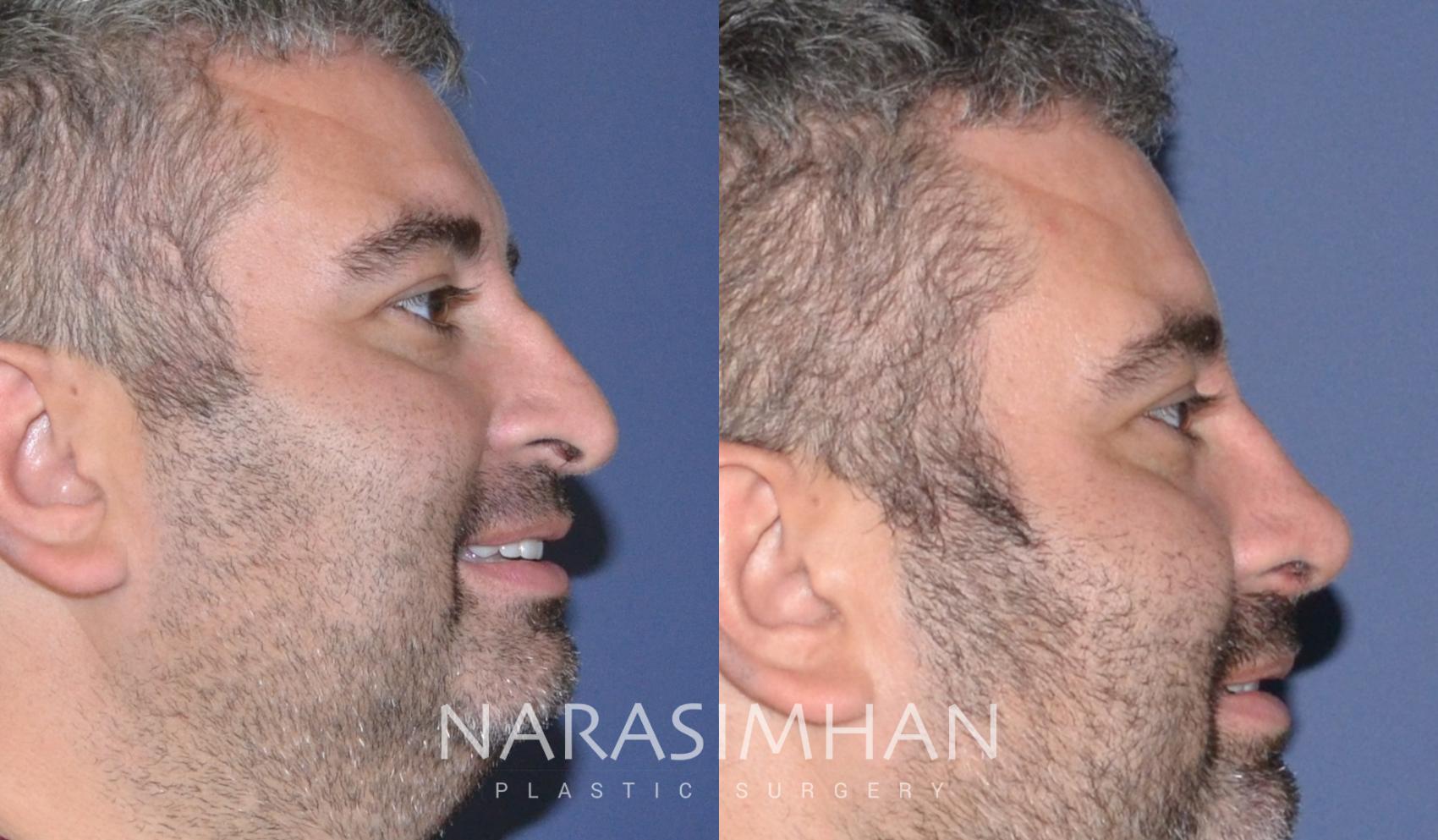 Before & After Rhinoplasty Case 134 View #1 View in St Petersburg, Florida