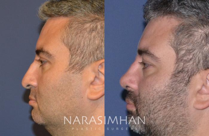 Before & After Rhinoplasty Case 134 View #2 View in Tampa, Florida