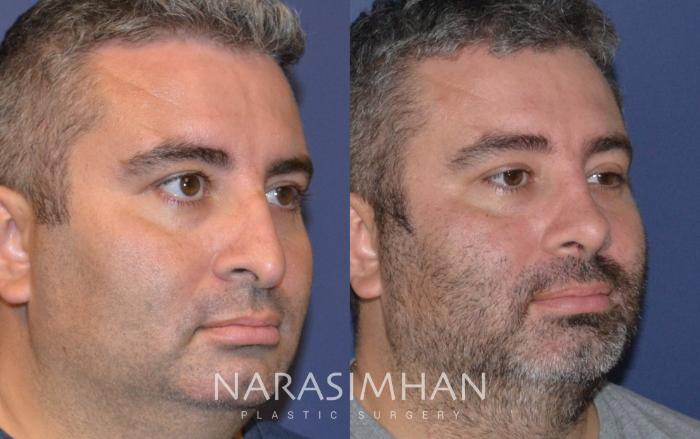 Before & After Rhinoplasty Case 134 View #3 View in Tampa, Florida