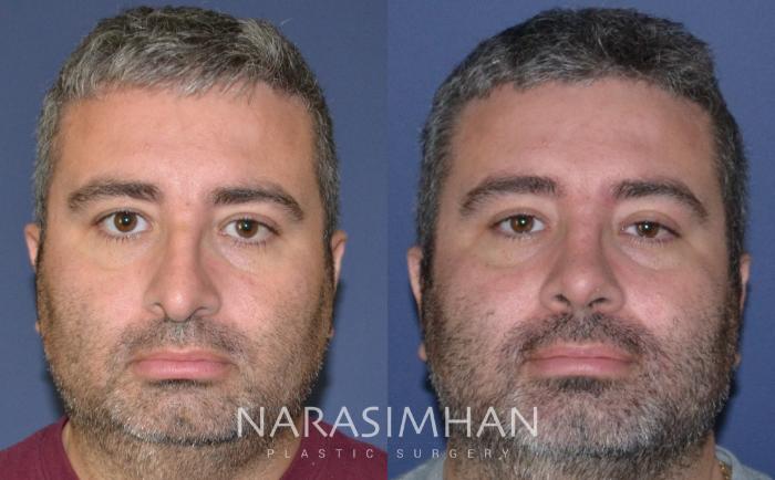 Before & After Rhinoplasty Case 134 View #4 View in Tampa, Florida