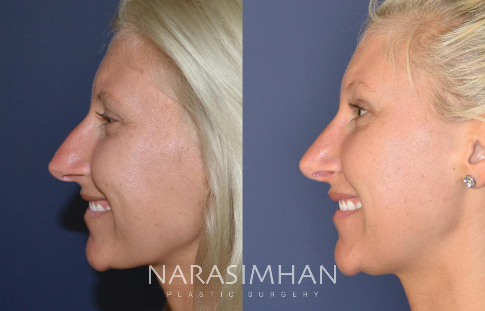 Before & After Rhinoplasty Case 138 View #1 View in St Petersburg, Florida