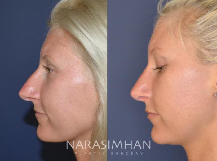 Before & After Rhinoplasty Case 138 View #2 View in Tampa, Florida