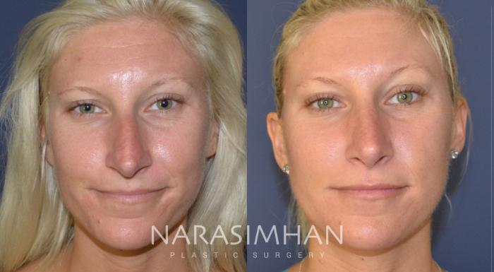 Before & After Rhinoplasty Case 138 View #4 View in Tampa, Florida