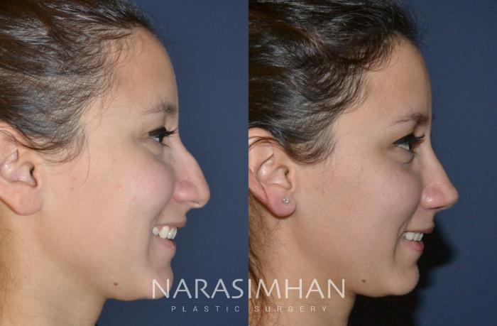 Before & After Rhinoplasty Case 139 View #1 View in Tampa, Florida