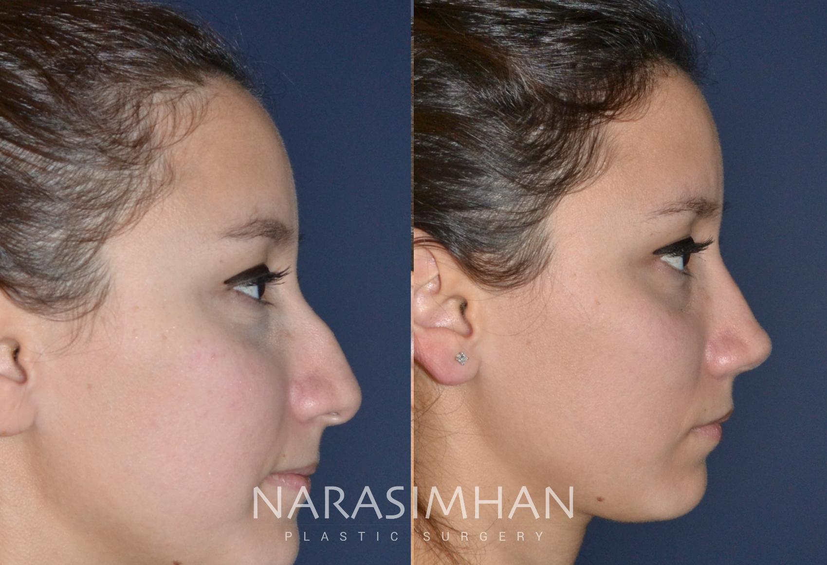 Before & After Rhinoplasty Case 139 View #2 View in St Petersburg, Florida