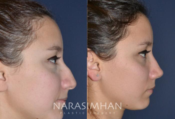 Before & After Rhinoplasty Case 139 View #2 View in Tampa, Florida