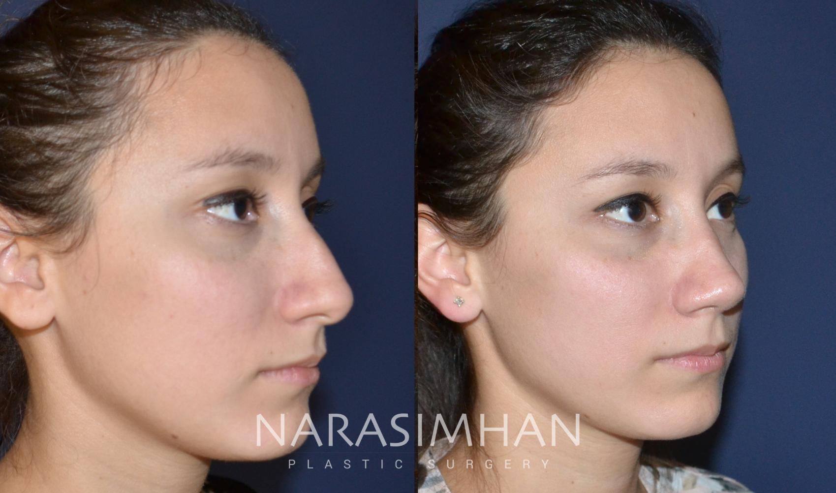 Before & After Rhinoplasty Case 139 View #3 View in St. Petersburg, Florida