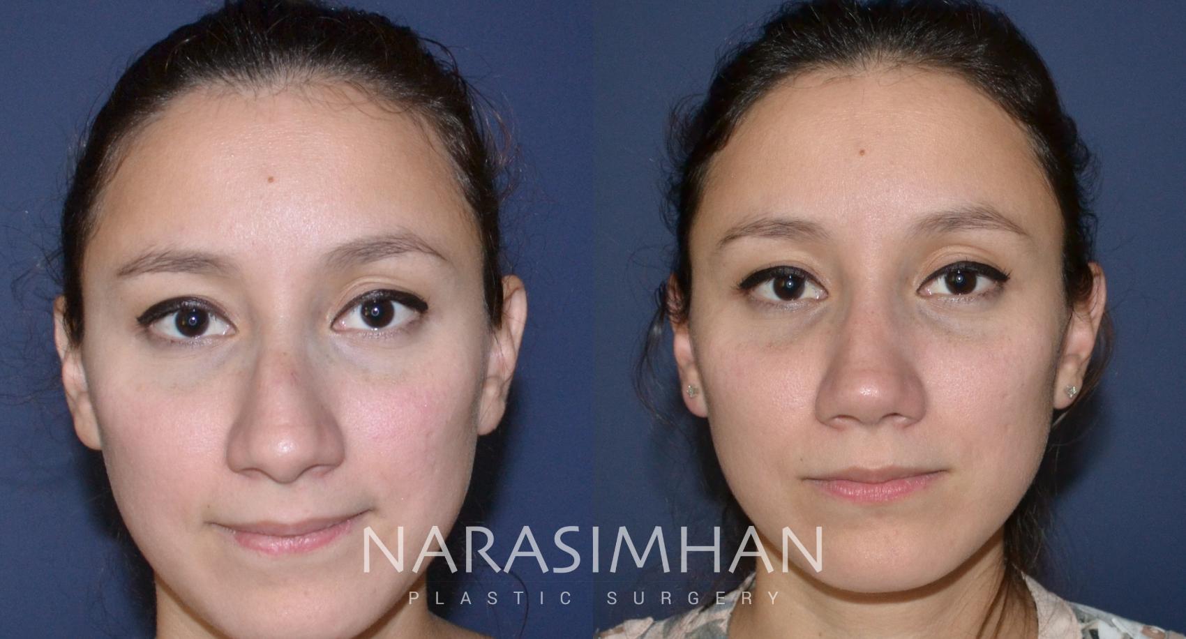Before & After Rhinoplasty Case 139 View #4 View in St Petersburg, Florida
