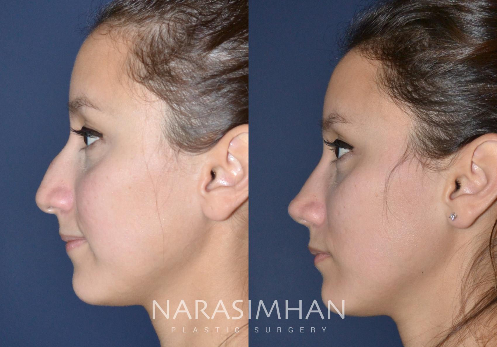 Before & After Rhinoplasty Case 139 View #5 View in St Petersburg, Florida