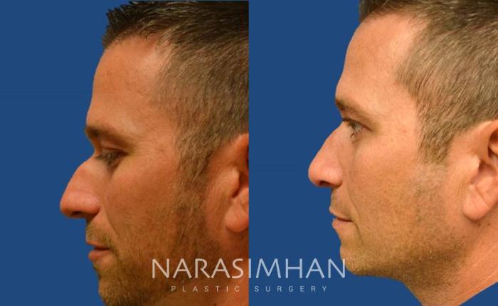 Before & After Rhinoplasty Case 14 View #1 View in Tampa, Florida