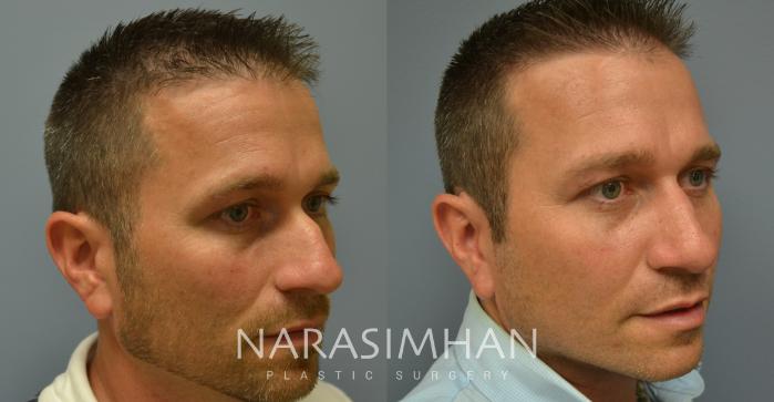 Before & After Rhinoplasty Case 14 View #2 View in Tampa, Florida