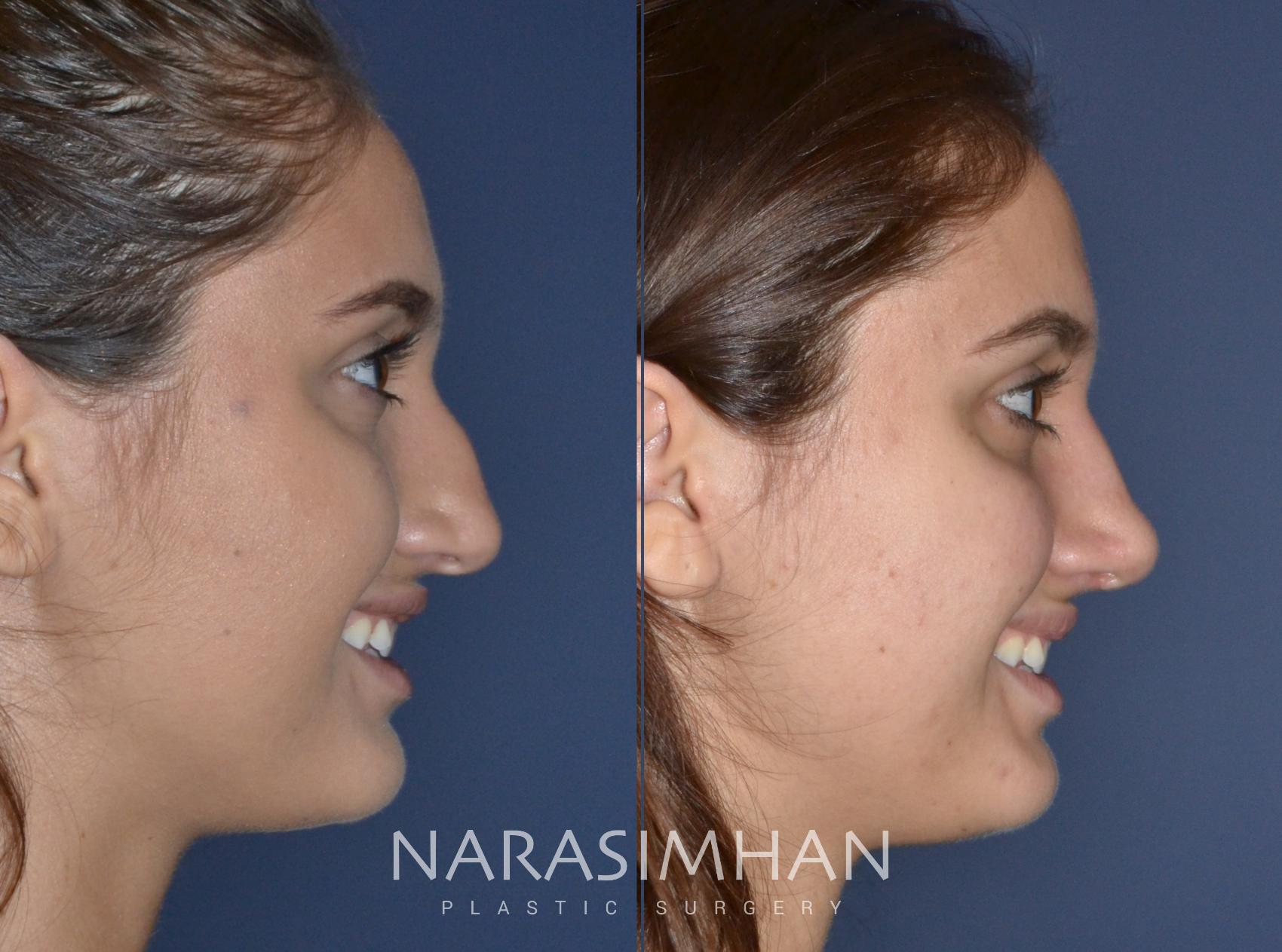 Before & After Rhinoplasty Case 149 View #1 View in St Petersburg, Florida