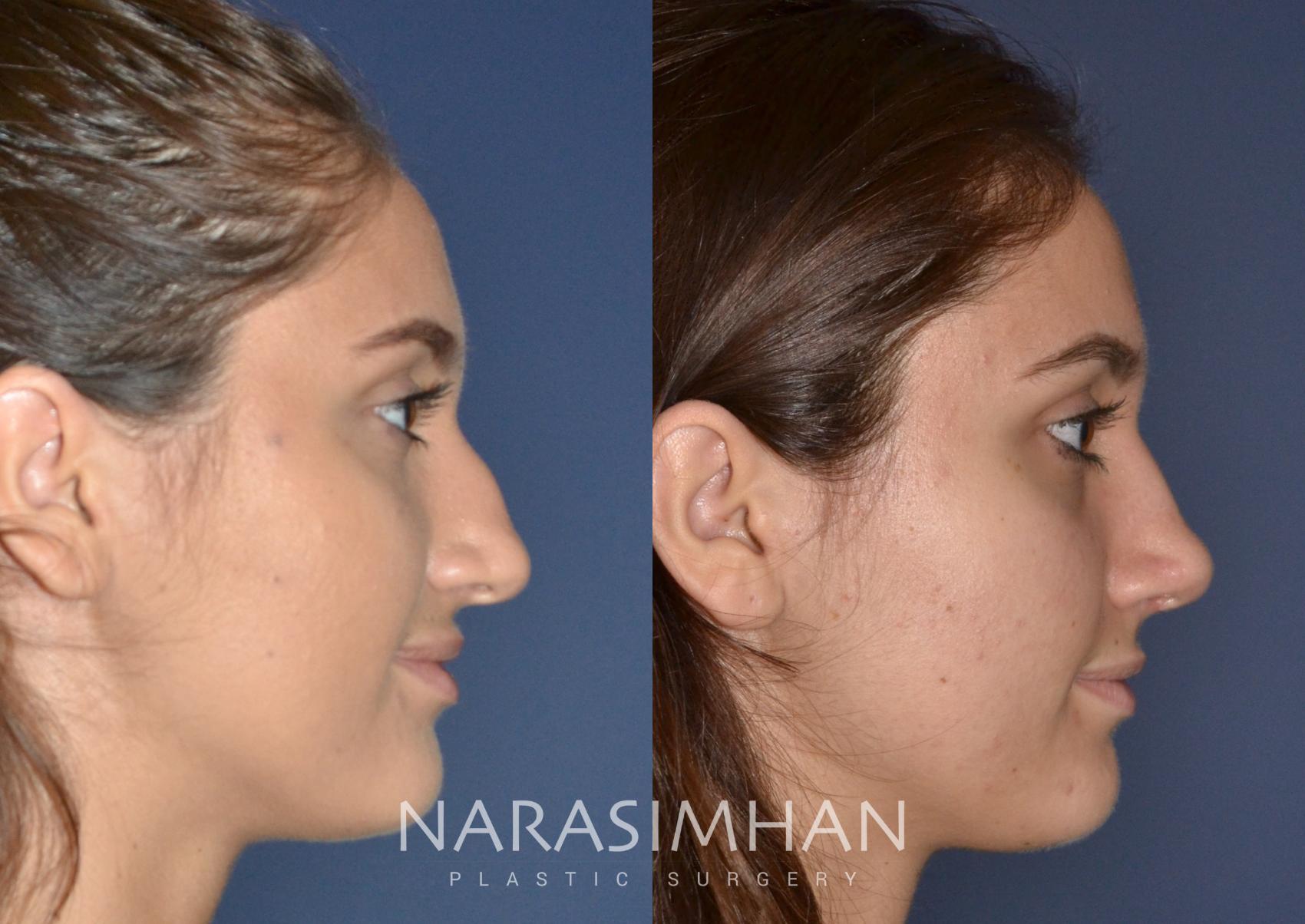 Before & After Rhinoplasty Case 149 View #2 View in St Petersburg, Florida