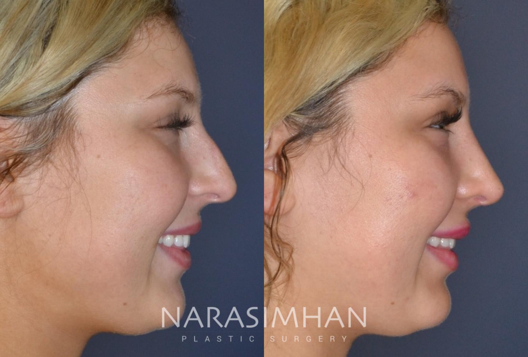 Before & After Rhinoplasty Case 151 View #1 View in Tampa, Florida