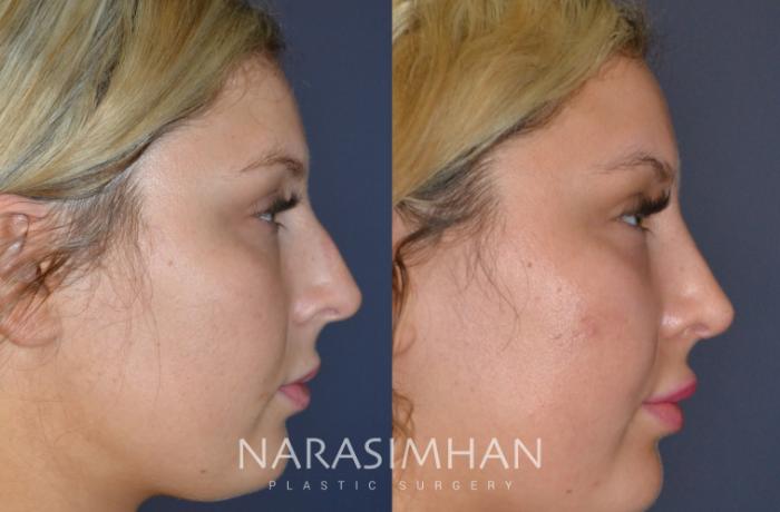 Before & After Rhinoplasty Case 151 View #2 View in Tampa, Florida