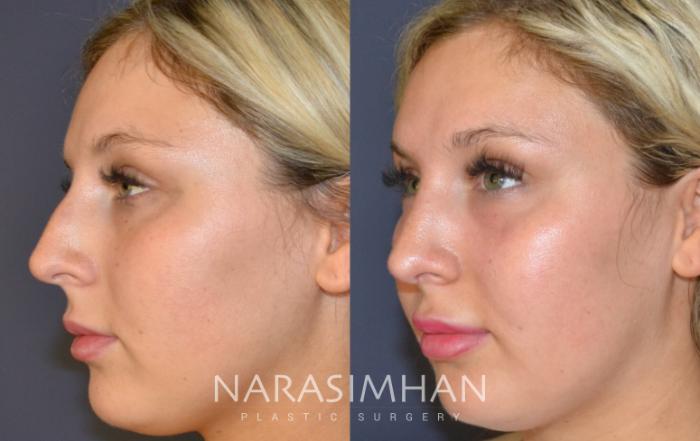 Before & After Rhinoplasty Case 151 View #3 View in Tampa, Florida