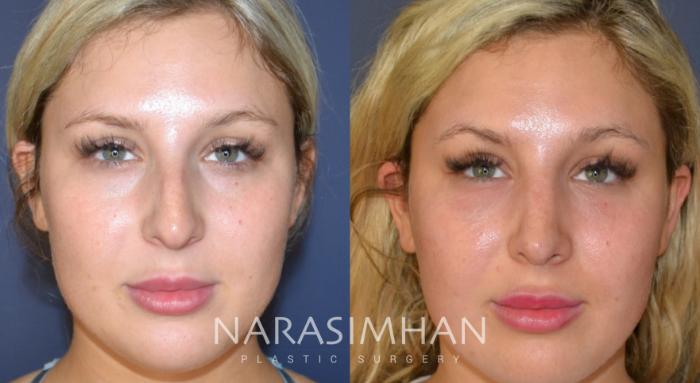Before & After Rhinoplasty Case 151 View #4 View in Tampa, Florida