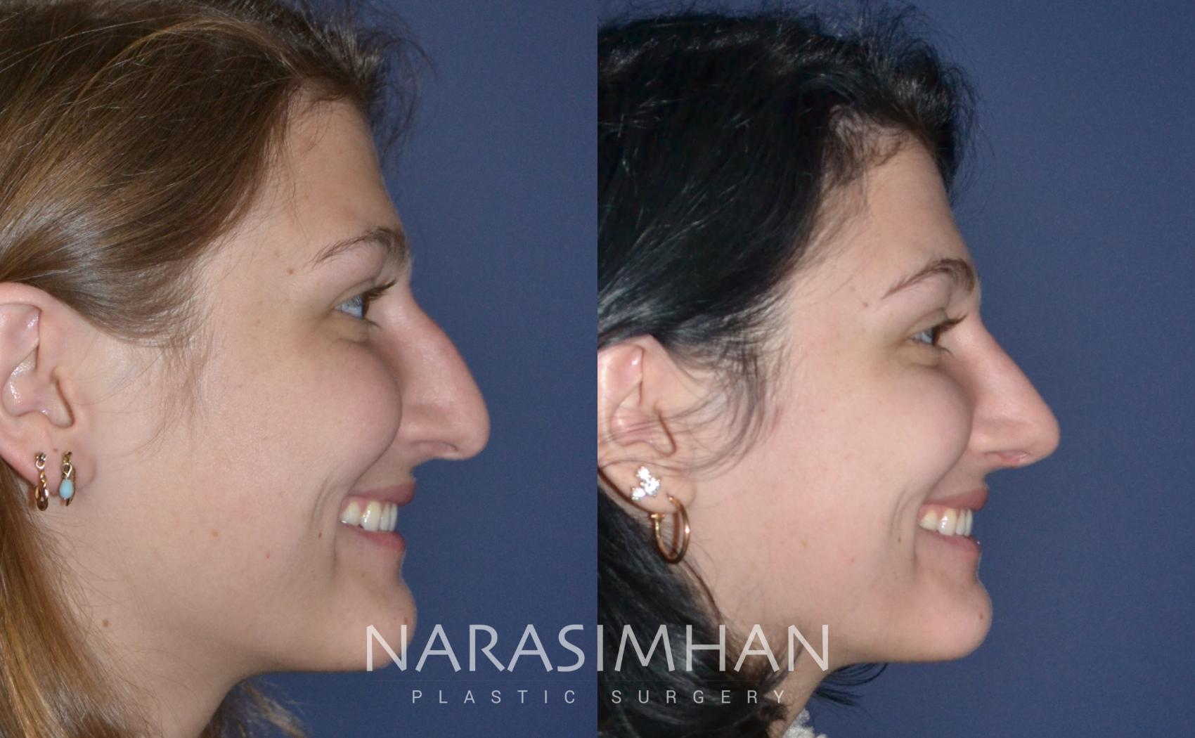 Before & After Rhinoplasty Case 153 View #1 View in St Petersburg, Florida
