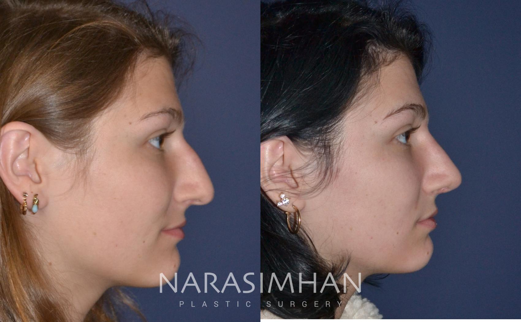 Before & After Rhinoplasty Case 153 View #2 View in St. Petersburg, Florida