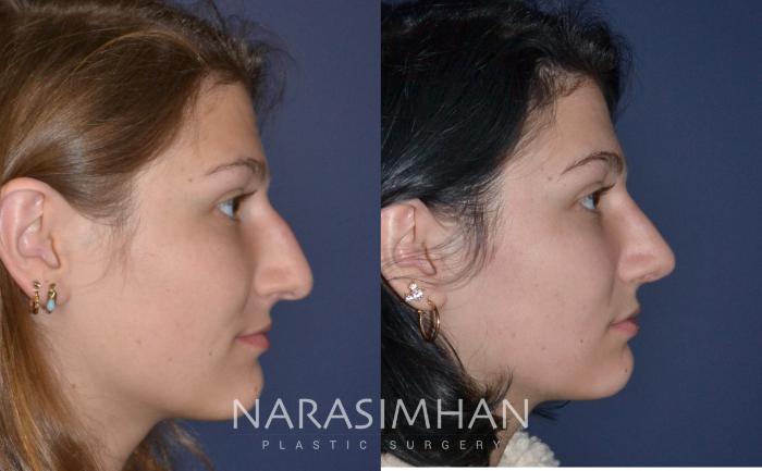 Before & After Rhinoplasty Case 153 View #2 View in Tampa, Florida