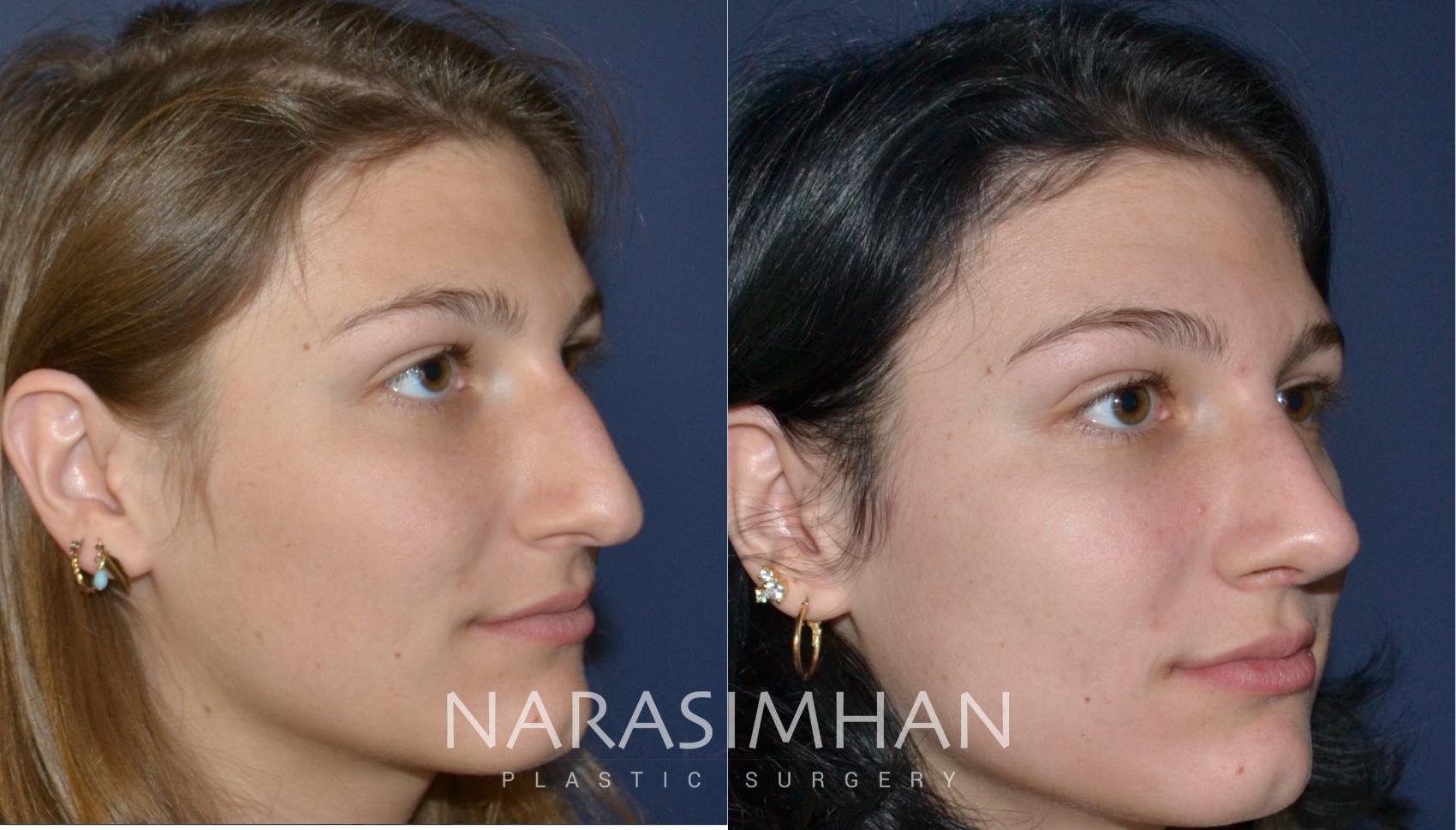 Before & After Rhinoplasty Case 153 View #3 View in St Petersburg, Florida