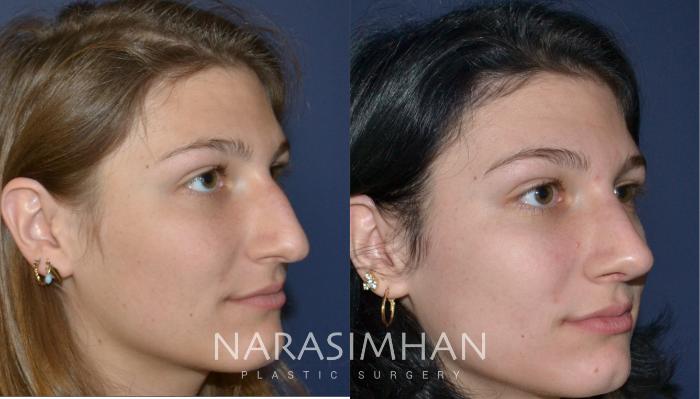 Before & After Rhinoplasty Case 153 View #3 View in Tampa, Florida