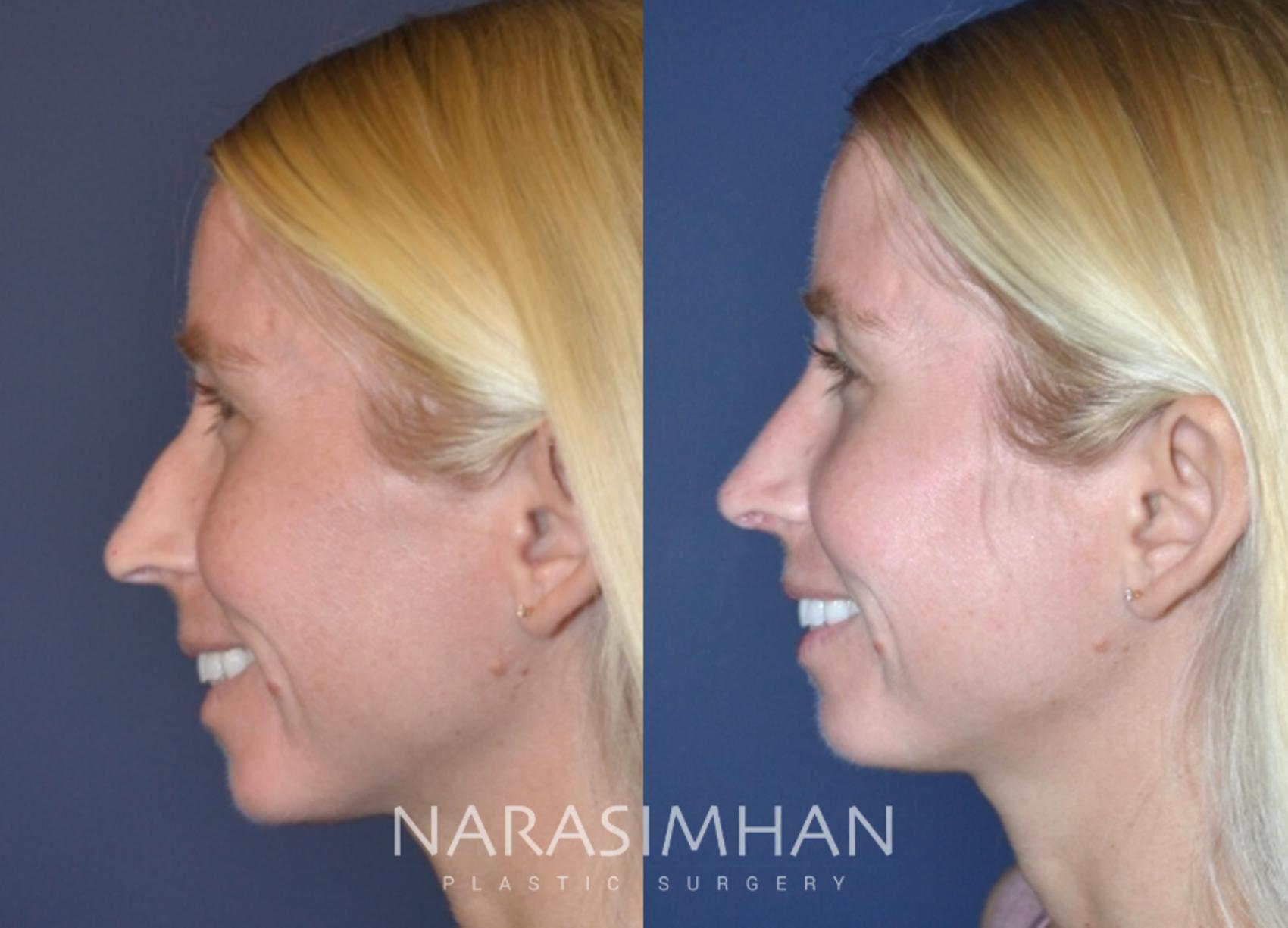 Before & After Rhinoplasty Case 160 View #1 View in St Petersburg, Florida
