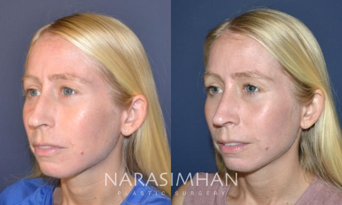 Before & After Rhinoplasty Case 160 View #2 View in Tampa, Florida