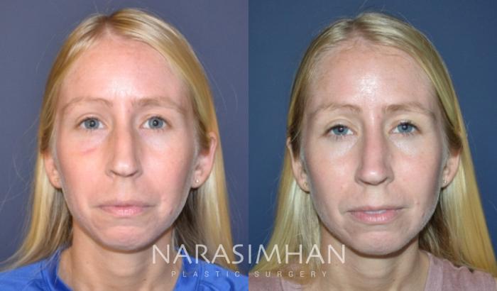 Before & After Rhinoplasty Case 160 View #3 View in Tampa, Florida