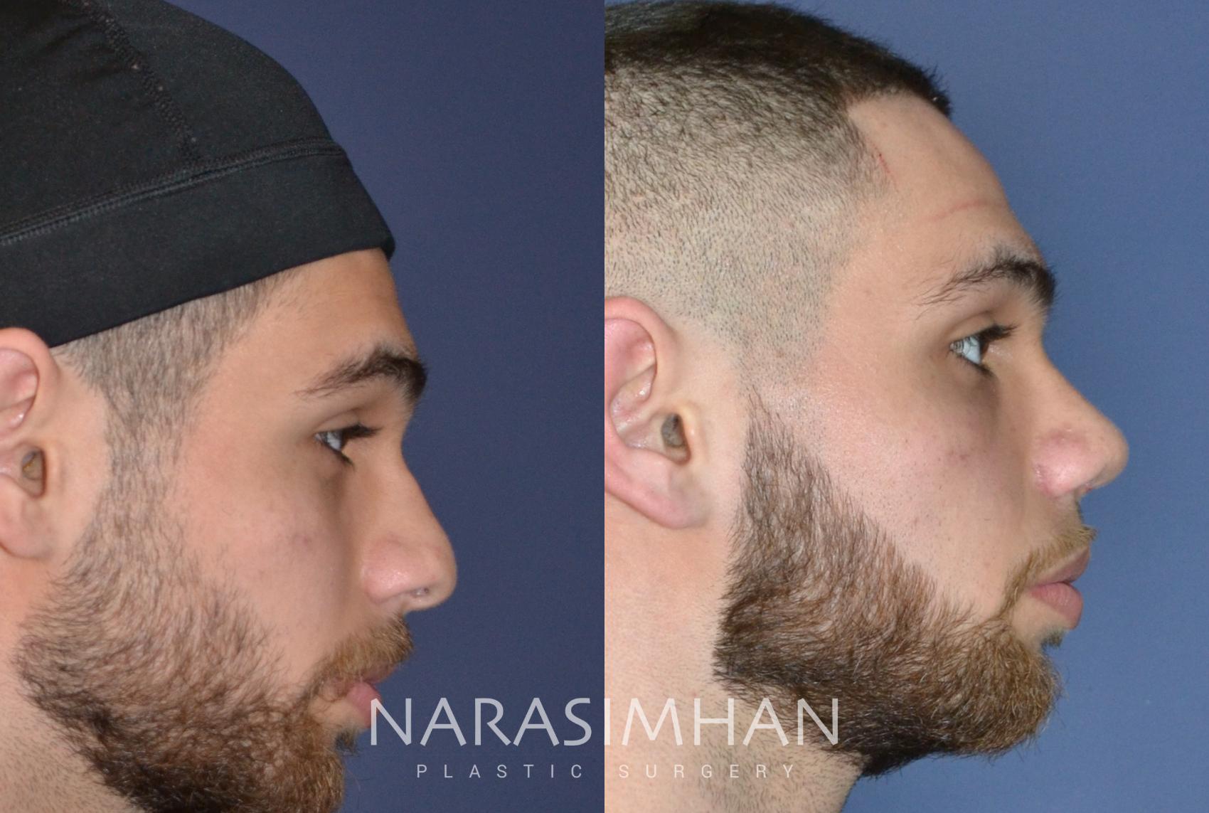 Before & After Rhinoplasty Case 161 View #1 View in St Petersburg, Florida