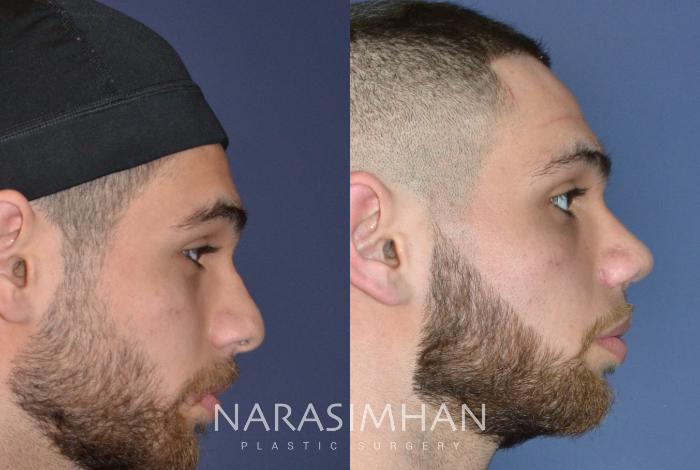 Before & After Rhinoplasty Case 161 View #1 View in Tampa, Florida