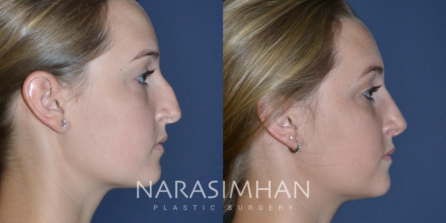 Before & After Rhinoplasty Case 166 View #1 View in St Petersburg, Florida