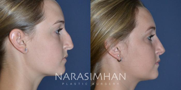 Before & After Rhinoplasty Case 166 View #1 View in Tampa, Florida