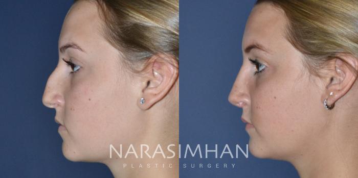 Before & After Rhinoplasty Case 166 View #2 View in Tampa, Florida