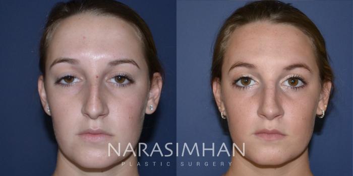 Before & After Rhinoplasty Case 166 View #3 View in Tampa, Florida