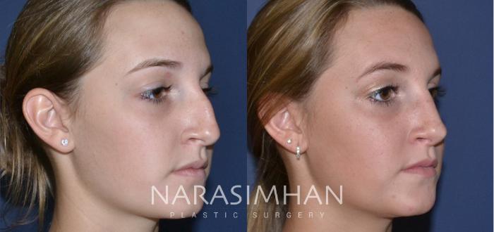 Before & After Rhinoplasty Case 166 View #4 View in Tampa, Florida