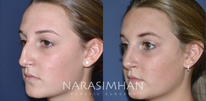Before & After Rhinoplasty Case 166 View #5 View in Tampa, Florida