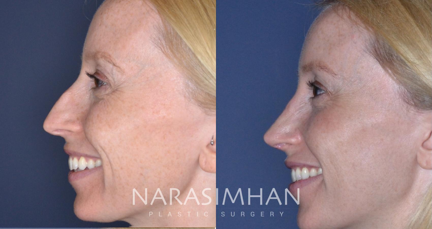 Before & After Rhinoplasty Case 167 View #1 View in St Petersburg, Florida